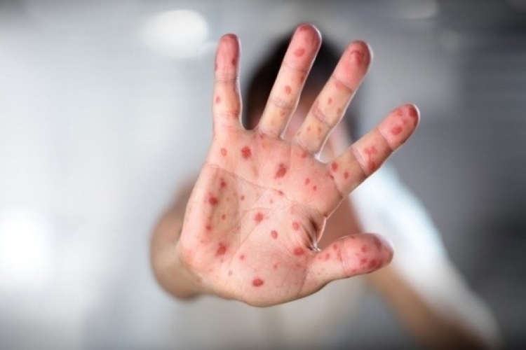 Assim como outras infecções virais, a síndrome mão-pé-boca se espalha rápido / imagem: DGCI - Saps